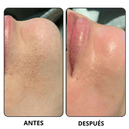 Peel Shot Coreano-Elimina las impurezas y realza tu piel