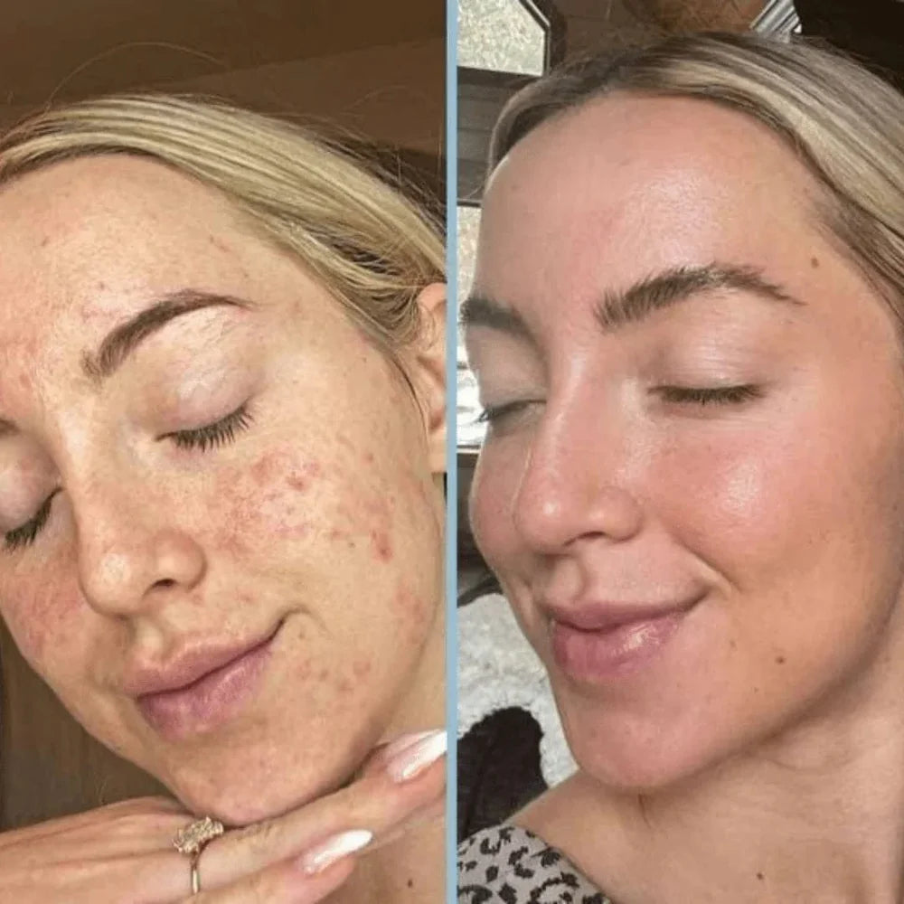 Adiós a las imperfecciones