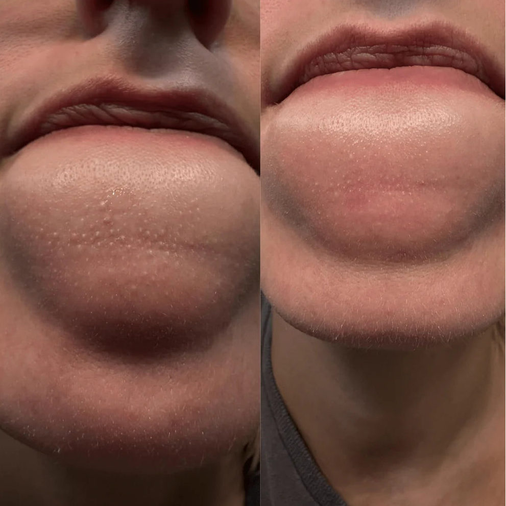 Resultados inmediatos