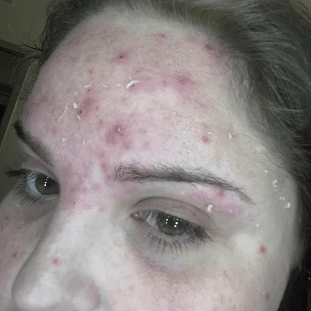 Perfecto incluso con rosácea