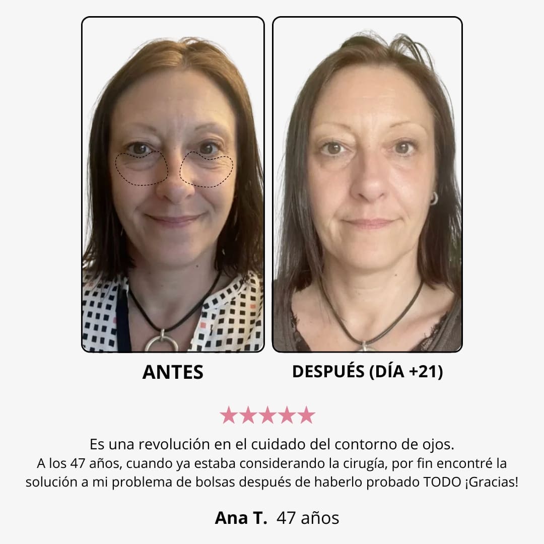 Crema de luz roja para el contorno de ojos