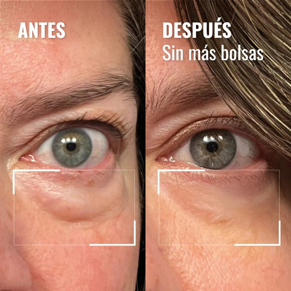 Crema de luz roja para el contorno de ojos